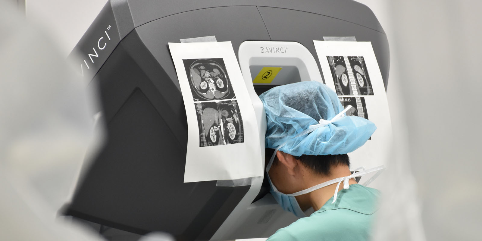 膀胱がんに対するロボット支援下手術