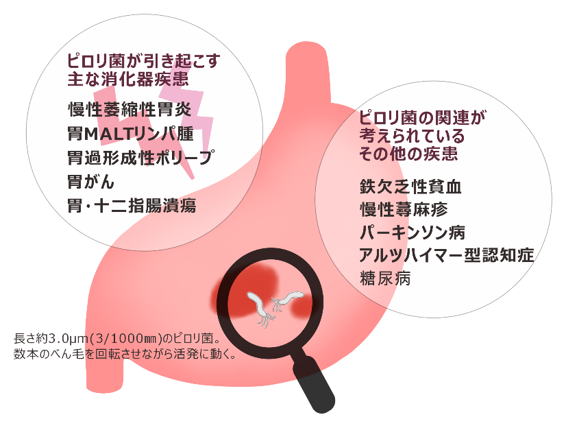ピロリ菌