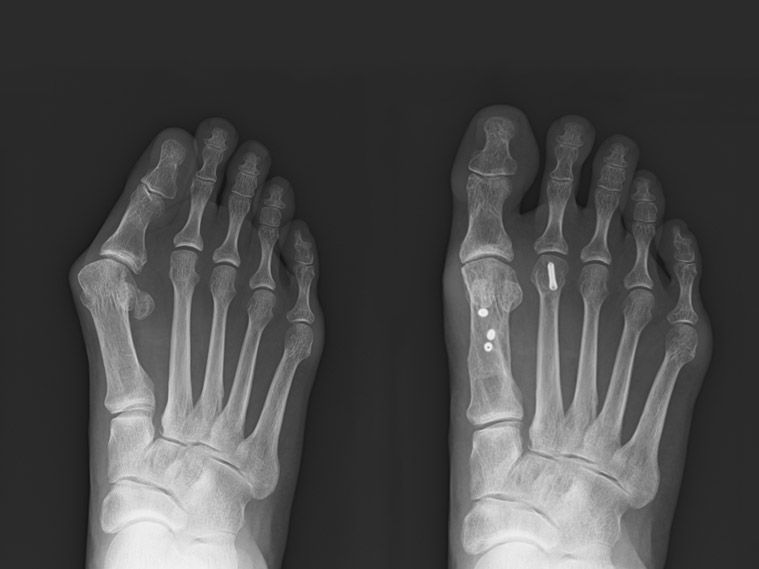 外反母趾（がいはんぼし）