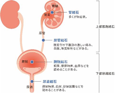 尿路結石